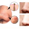 4-in-1 Beauty Device – Guasha, Cupping, Blackhead Removal & Deep Facial Cleansing