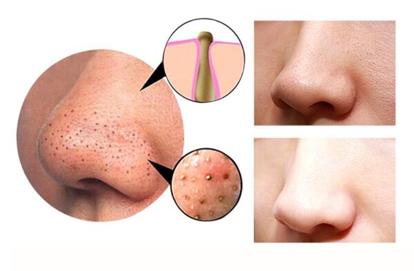 4-in-1 Beauty Device – Guasha, Cupping, Blackhead Removal & Deep Facial Cleansing