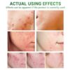 Acne Treatment Serum Facial Repair Oil