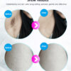 Laser Hair Removal Equipment