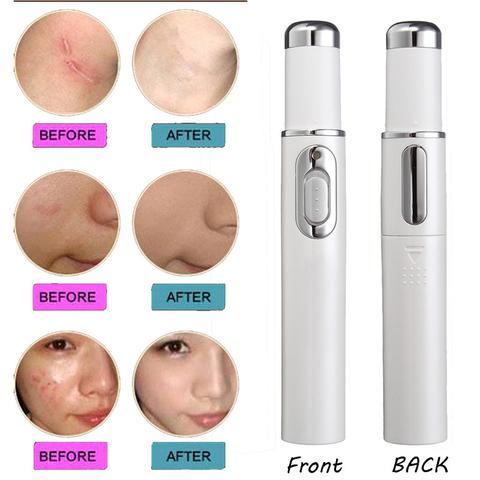 Blue Light Therapy Pen – Acne, Scar & Wrinkle Treatment Devic